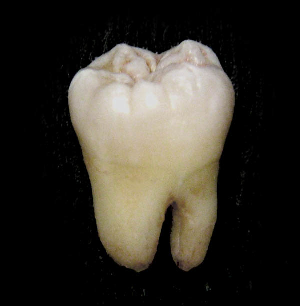 Prema zapažanju Petra Bakule, div iz Čerina imao je gotovo 3 puta veću poprečnu debljinu kutnjaka od današnjeg čovjeka (Wikimedia (wikimedia.org))